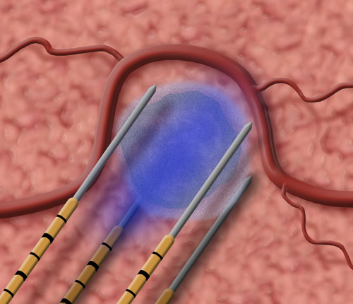 NanoKnife device for irreversible electroporation cancer treatment